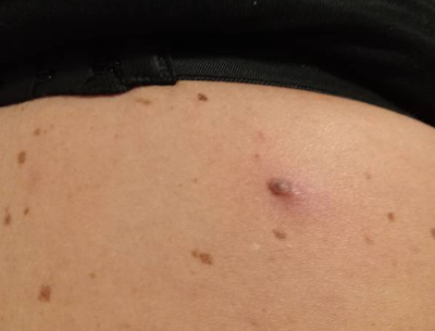 쥐젖 연성섬유종의 원인과 제거방법, 당뇨병과의 관계, 예방방법