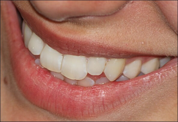 잇몸이 붓는 이유 2