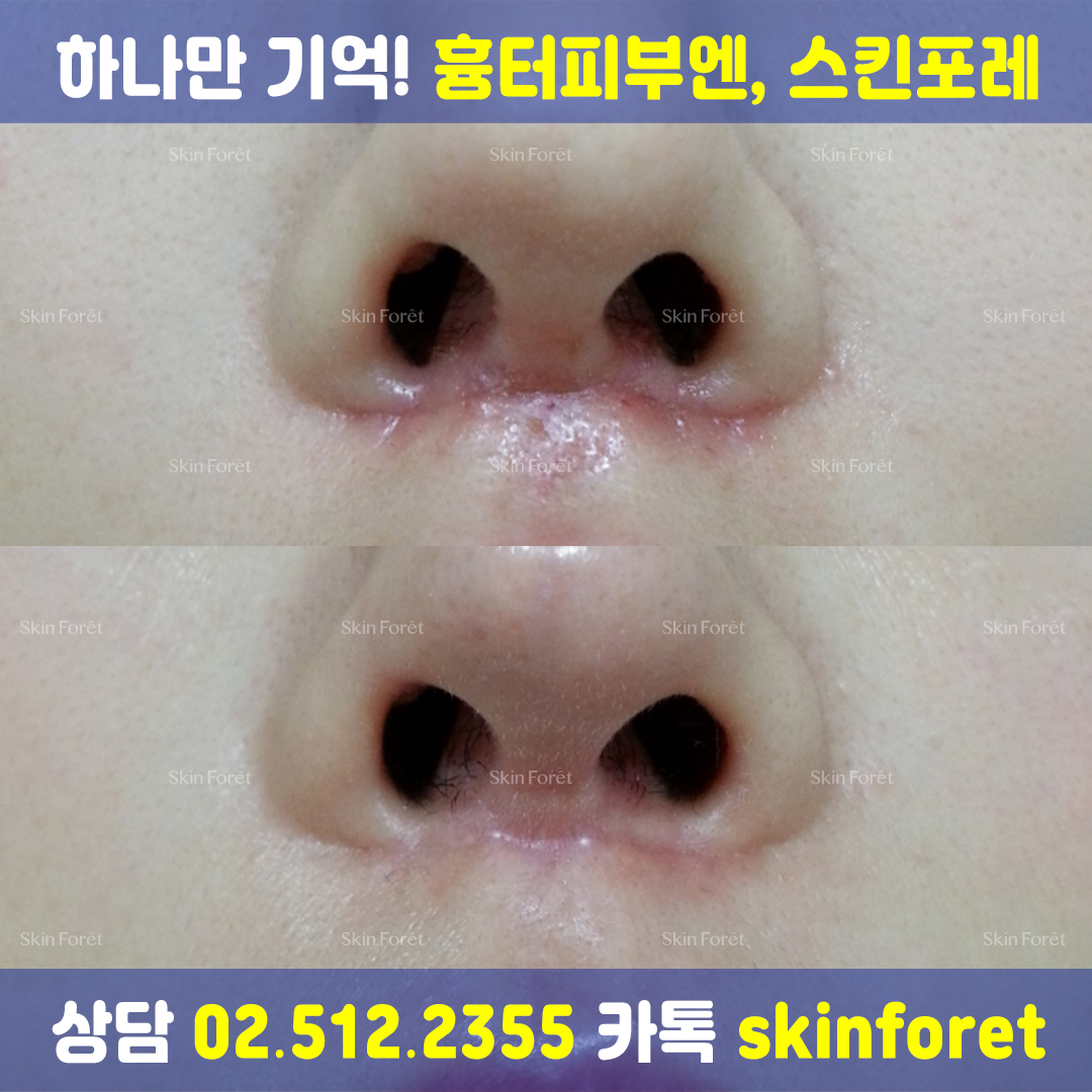 코 수술 후 흉터 케어 전후, 스킨포레 흉터케어 적용 사례
