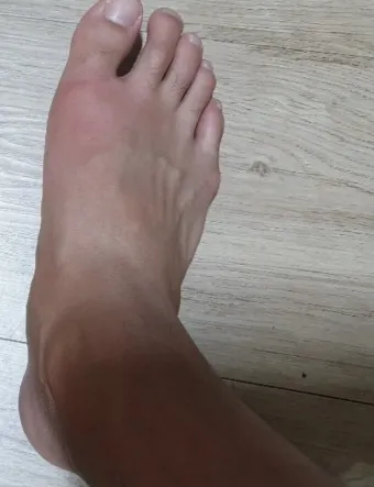 발가락 통풍 증상 및 대처방법_12