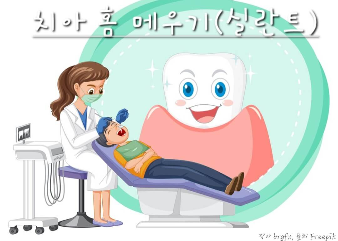 치아 홈 메우기 실란트