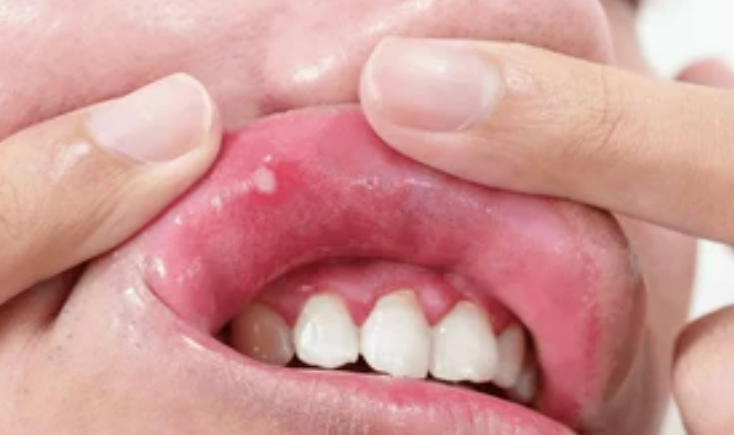 구내염의_증상_원인_치료법