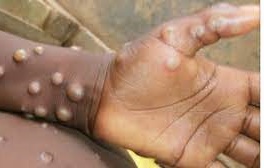 천연두와 원숭이 두창