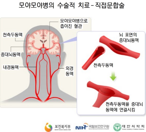 모야모야병