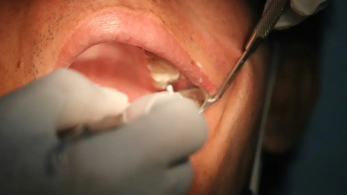 편도결석 원인부터 제거 방법까지, 입냄새의 정체를 파헤쳐보자!