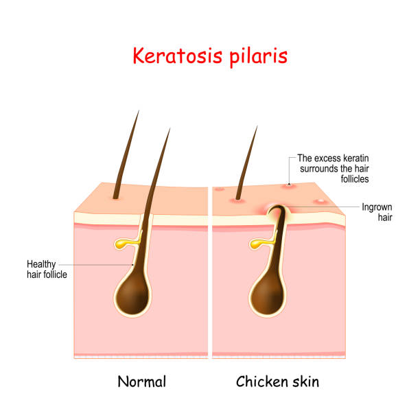모공 각화증 닭살 피부 바세린 바셀린 로션 바디 스크럽 가려움 통증 치료 연고