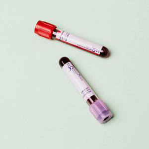 치매 검사 방법 - 혈액검사