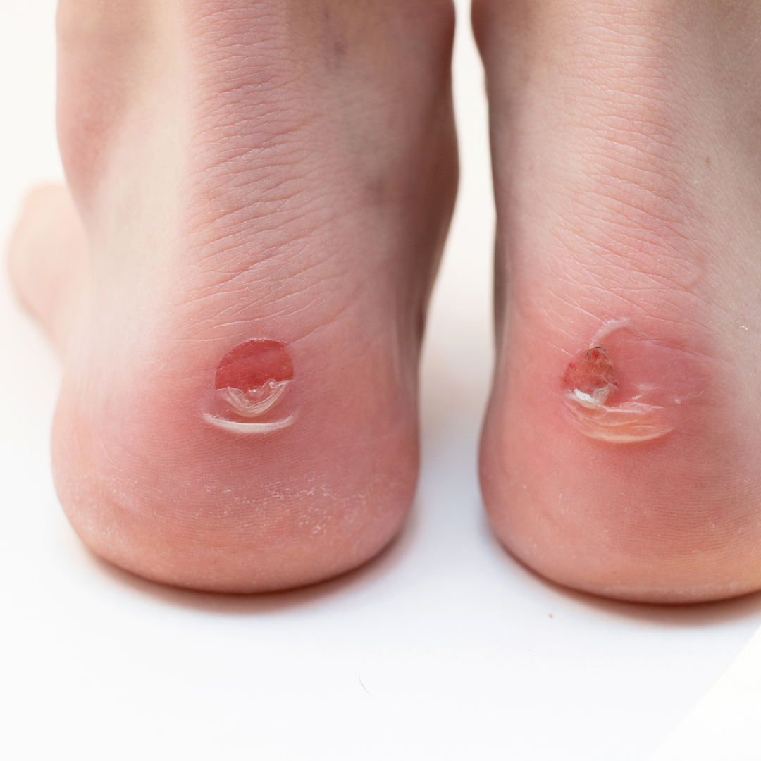 티눈과 굳은살 차이와 치료법, 발바닥 혹 없애는 법