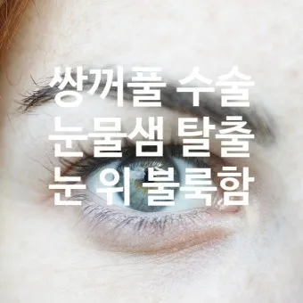 눈물샘 뚫는 수술 간단한가요에 대한 수술정보_19