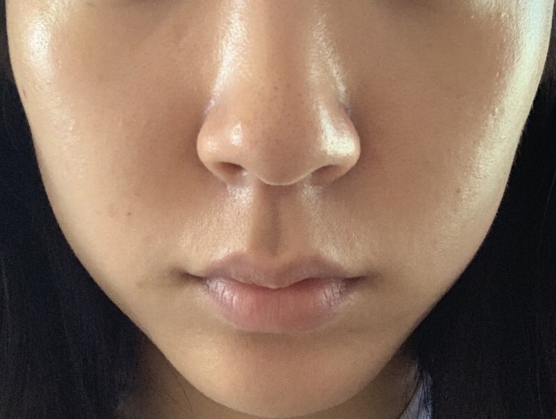 콧볼 보톡스 후기