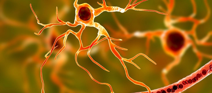 다발성 경화증 진단기준