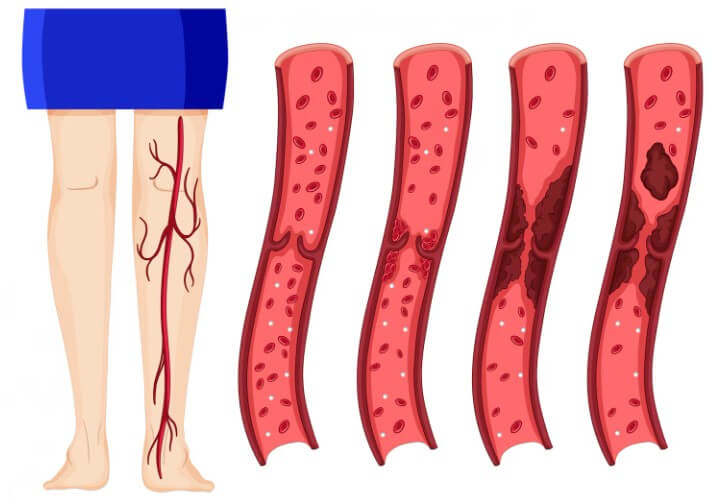 다리 혈관 속 찌꺼기 상태를 보여주는 모습
