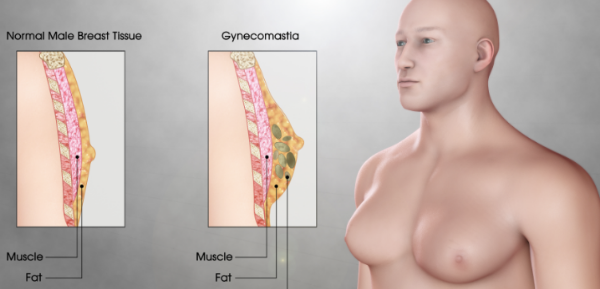 소아 비만 여유증
