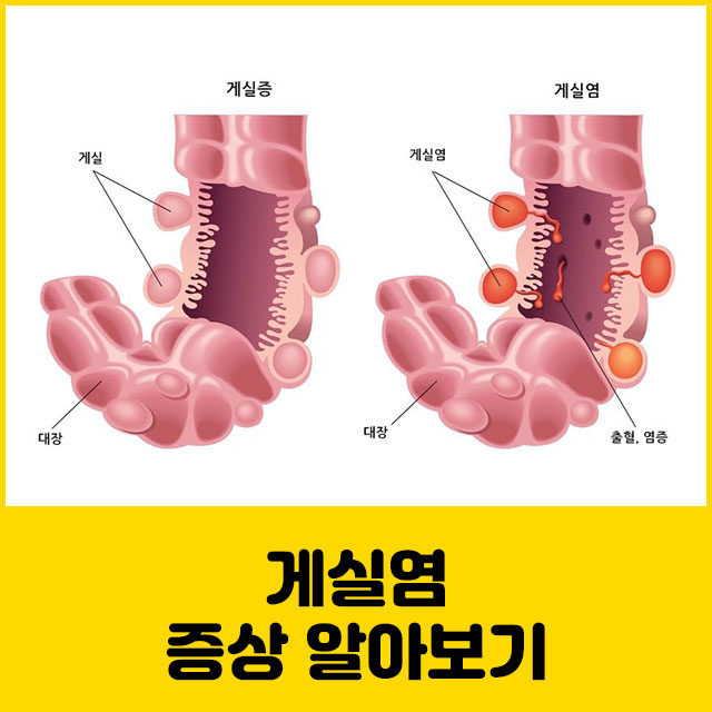 게실염 증상