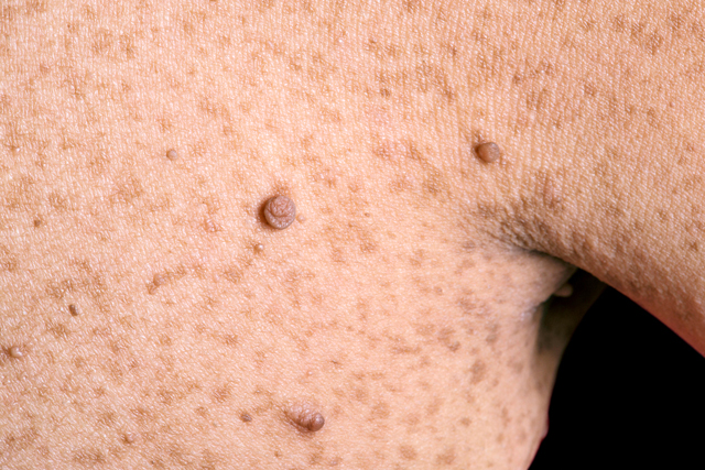 편평사마귀와-쥐젖의-차이와-전염성과-제거방법과-제거후-관리방법에-대해서