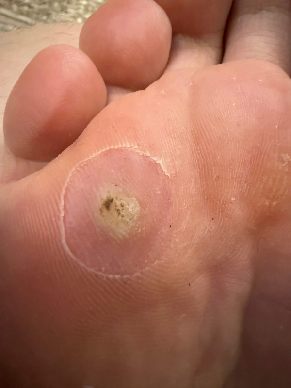 족저사마귀-치료-3일차-사진