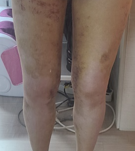 복부지방흡입 후기