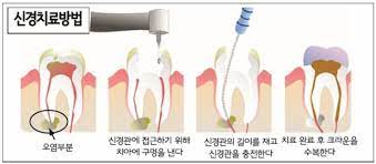 치아 신경치료