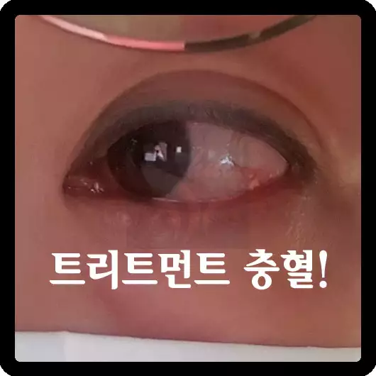 트리트먼트로 인한 눈 충혈과 따가움