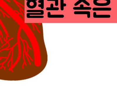 관상동맥 석회화 증상