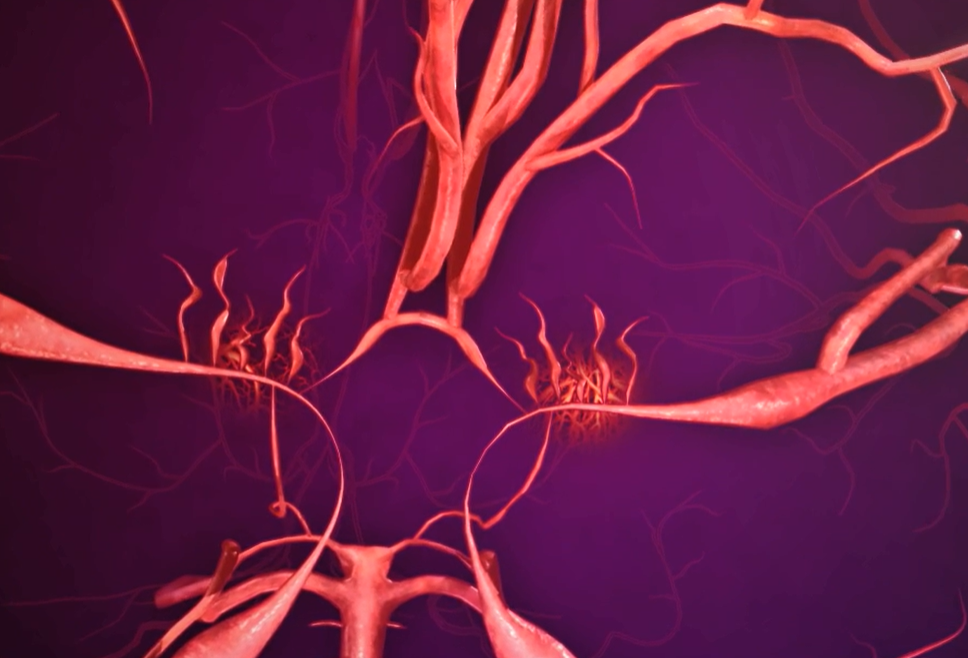 모야모야병 증상