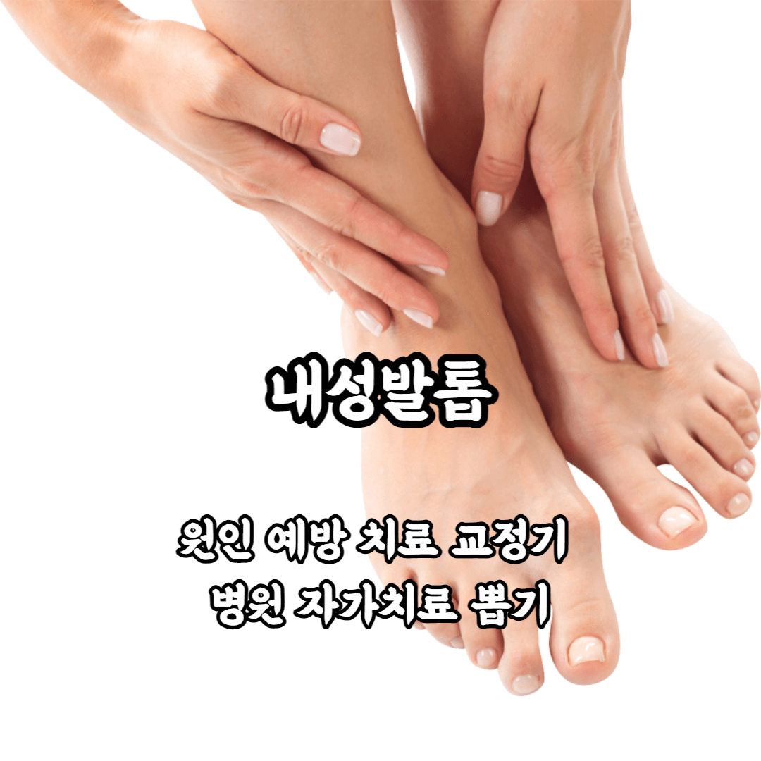 내성 발톱 내향성 발톱 원인 예방 치료 교정기 병원 자가치료 뽑기