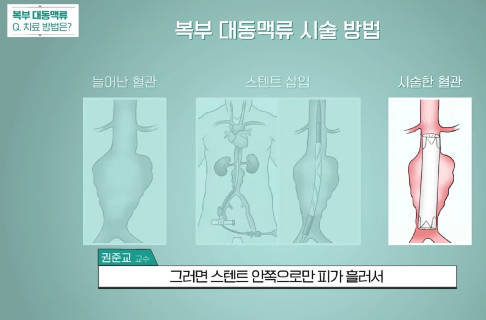 강진모-교수-혈관외과