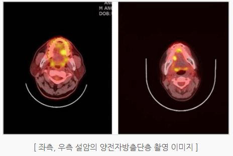 설암 검사 치료방법