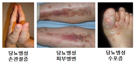 당뇨병성 피부병번