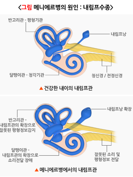 메니에르병