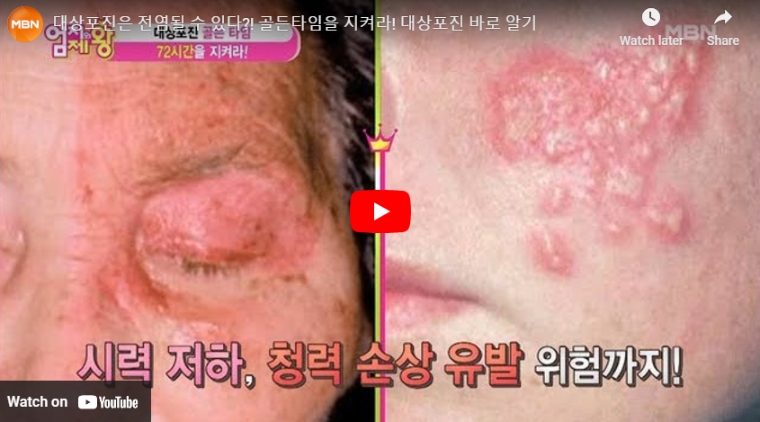 대상포진 전염성 영상