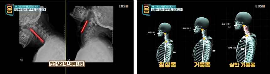 완전 일자목, 심한 거북목