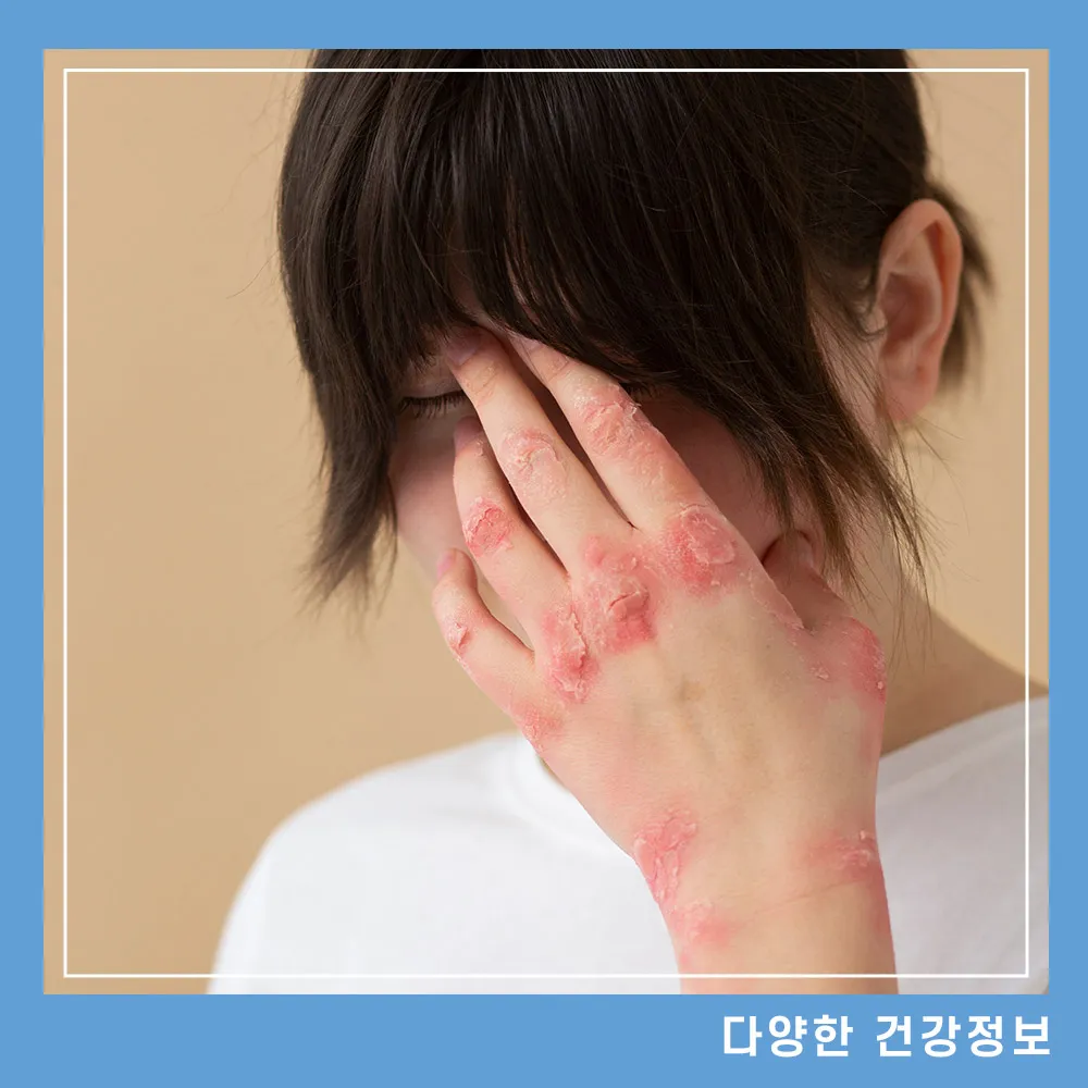 대상포진 초기증상 치료방법