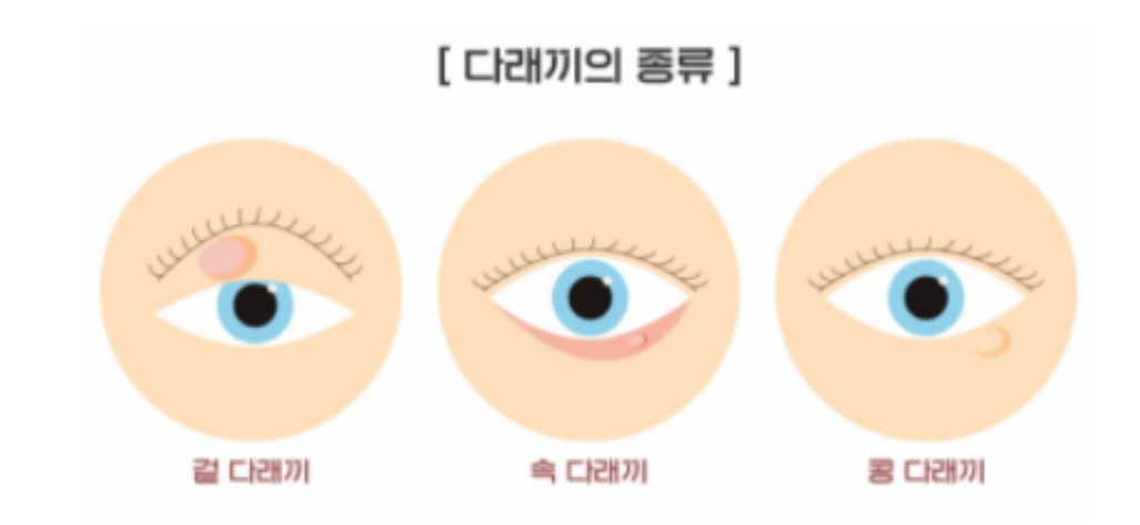 다래끼-종류