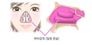 비염 수술