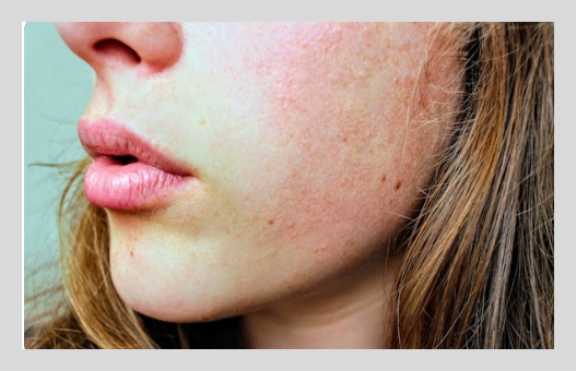 점뺀후 재생테이프 붙이는 기간