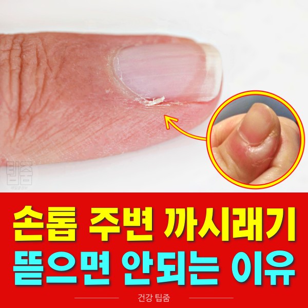 손톱 주변 살, 까시래기 거스러미, 손톱 옆 갈라짐 염증, 건강 팁줌 매일꿀정보
