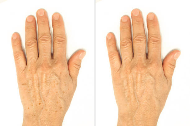 검버섯 제거 레이저 비용, 보험 적용 가능할까?