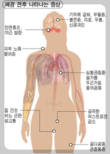 폐경후 증상