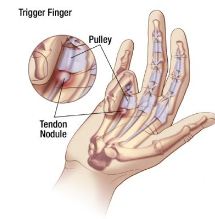 손가락-마디-통증-치료방법