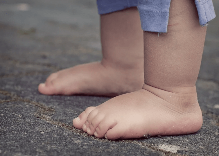 다리가 부은 아기