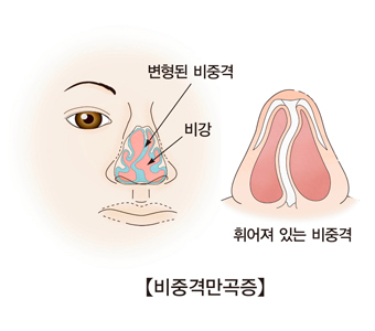 비중격 비강