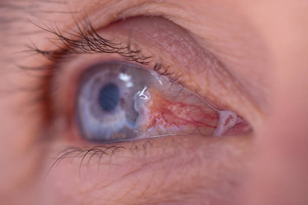 결막낭종 치료 수술 물집 원인 치료 제거 안과 원인 눈 흰자 이물감 결막 물혹 낭종 맑은 액체 투명한 증상 눈에 혹