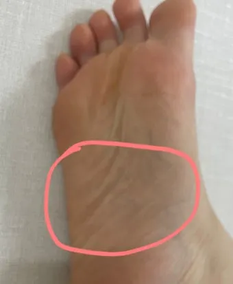 발바닥통증의 원인들과 해결책_12