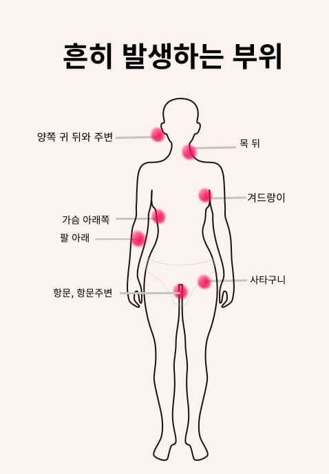 화농성 한선염 발생 부위