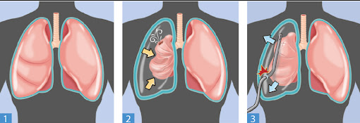 폐기흉 증상 뜻 원인 수술 비용 치료 호흡 곤란 예방법 총정리 3