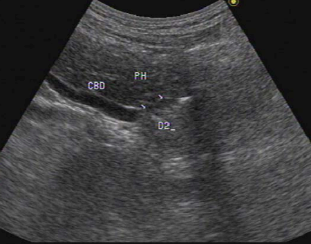 extrahepatic bile duct