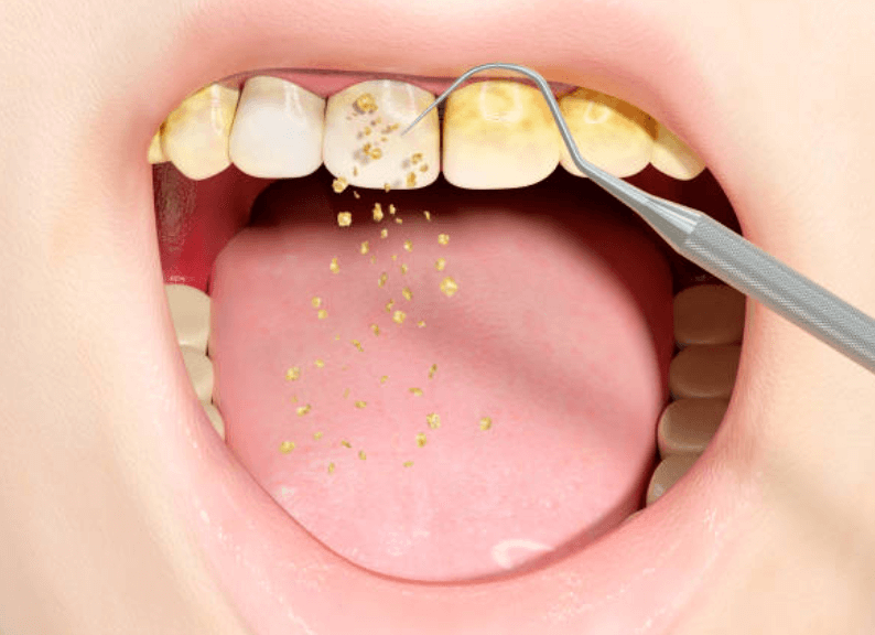 치과 스케일링 가격