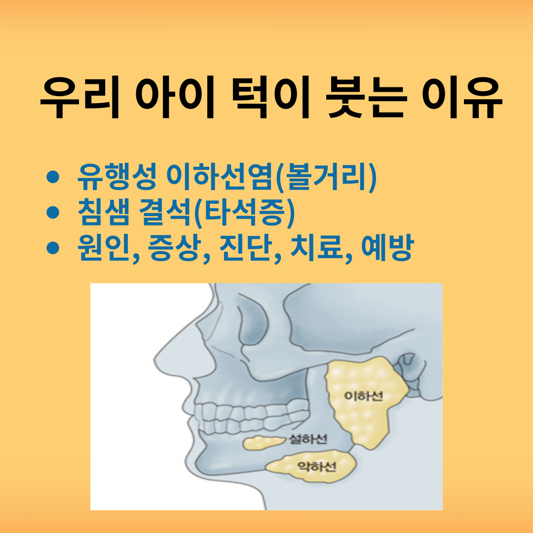 유행성 이하선염 vs 침샘 결석, 우리 아이 턱이 붓는 이유