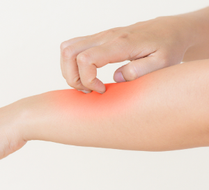 모기 물려서 가려울 때